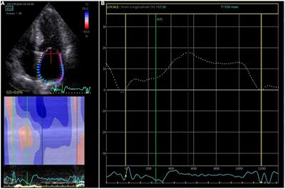 Left atrial function after standalone totally thoracoscopic left atrial appendage exclusion in atrial fibrillation patients with absolute contraindication to oral anticoagulation therapy